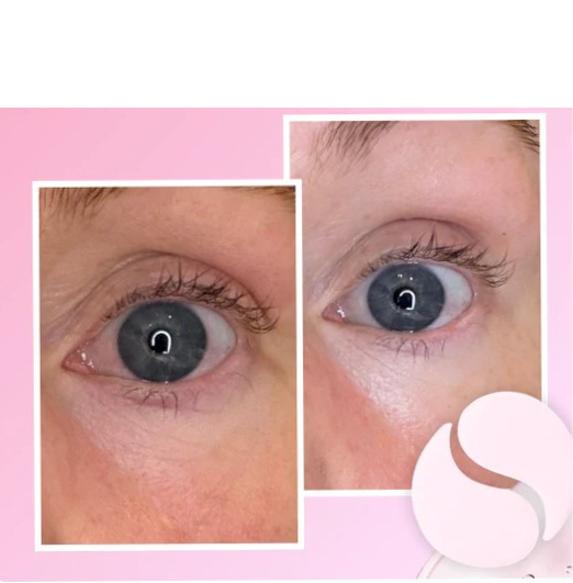 Instalift-Ögonpatches